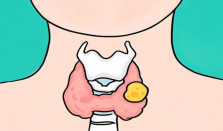 甲状腺癌为什么越来越常见 甲状腺癌是我国发病率第三的恶性肿瘤