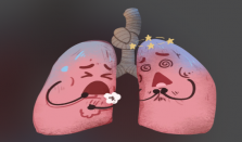 发热1天左肺全白这病别误当普通感冒 塑型性支气管炎常见于2~12岁儿童