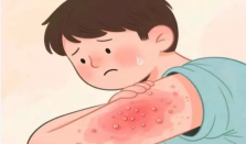 湿疹怕热还是怕冷? 湿疹患者适合去什么地方旅行